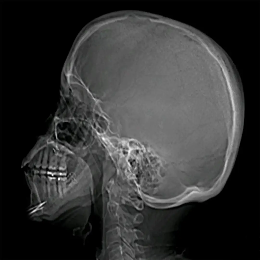 X-RAY SKULL LAT VIEW