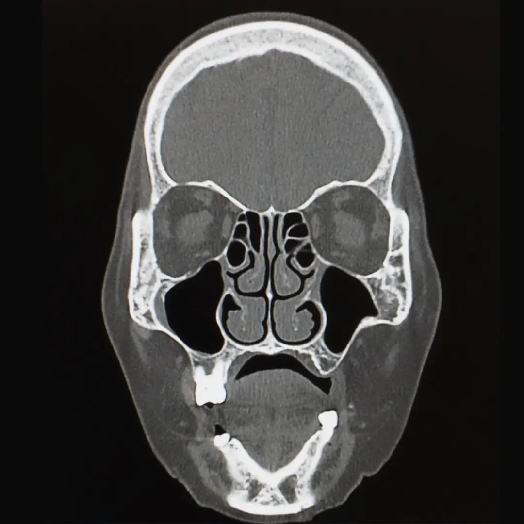 X-RAY SKULL CORONAL VIEW