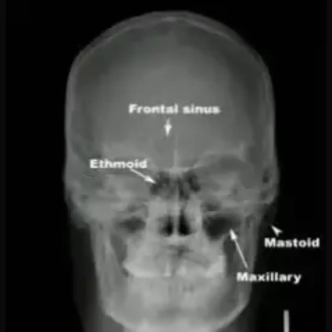 X-RAY PARANASAL SINUS AP VIEW
