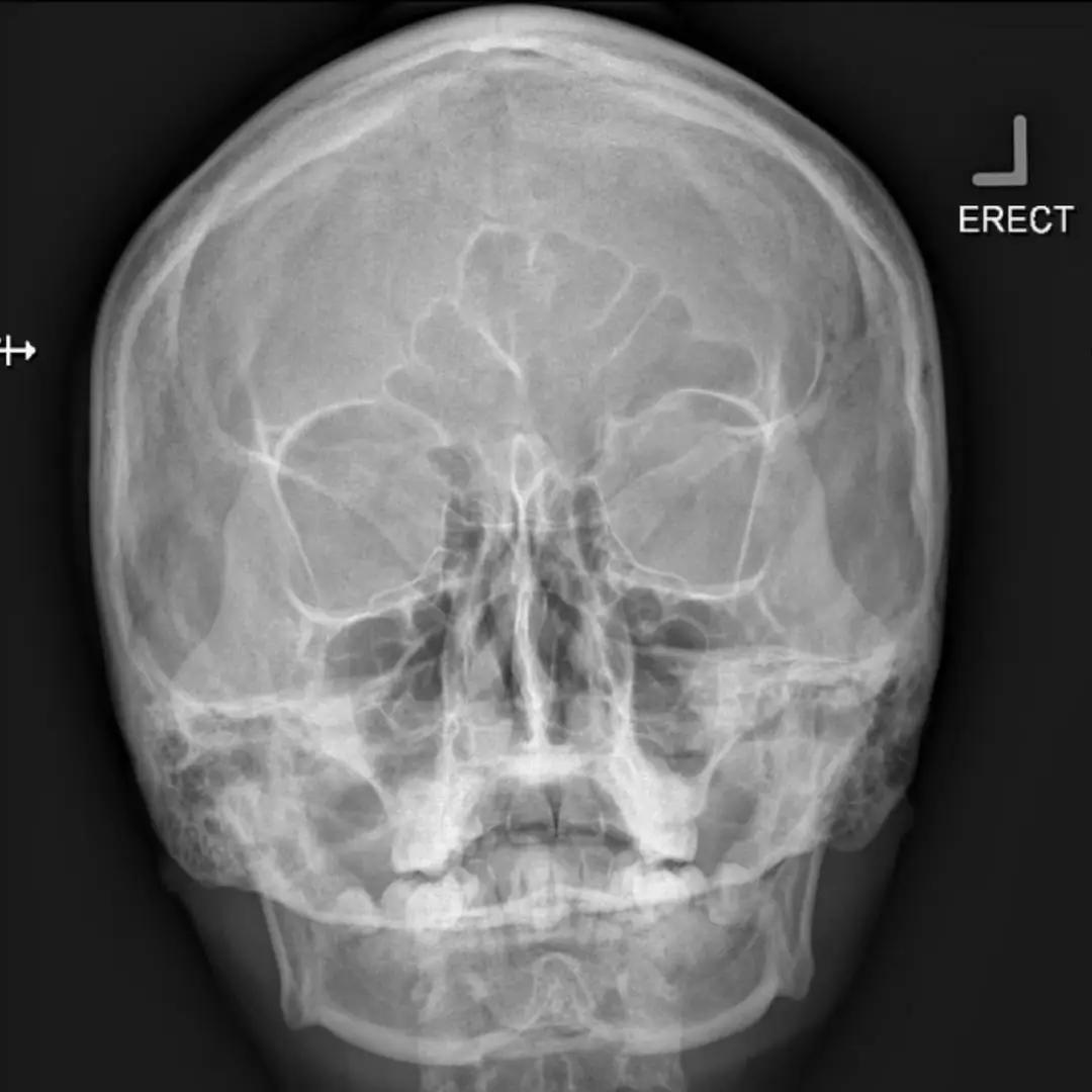 X-RAY PARANASAL SINUS CORONAL VIEW