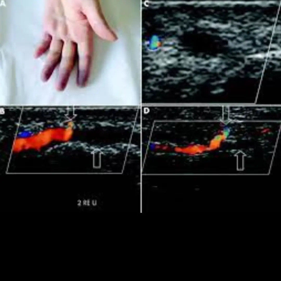 USG SMALL PART DOPPLER