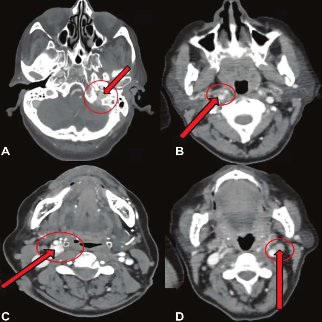 CECT HEAD (CONTRAST)