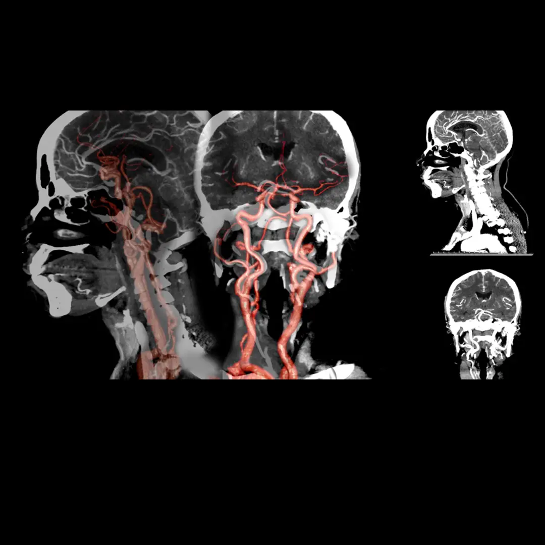 CECT BRAIN ANGIOGRAPHY (CONTRAST)