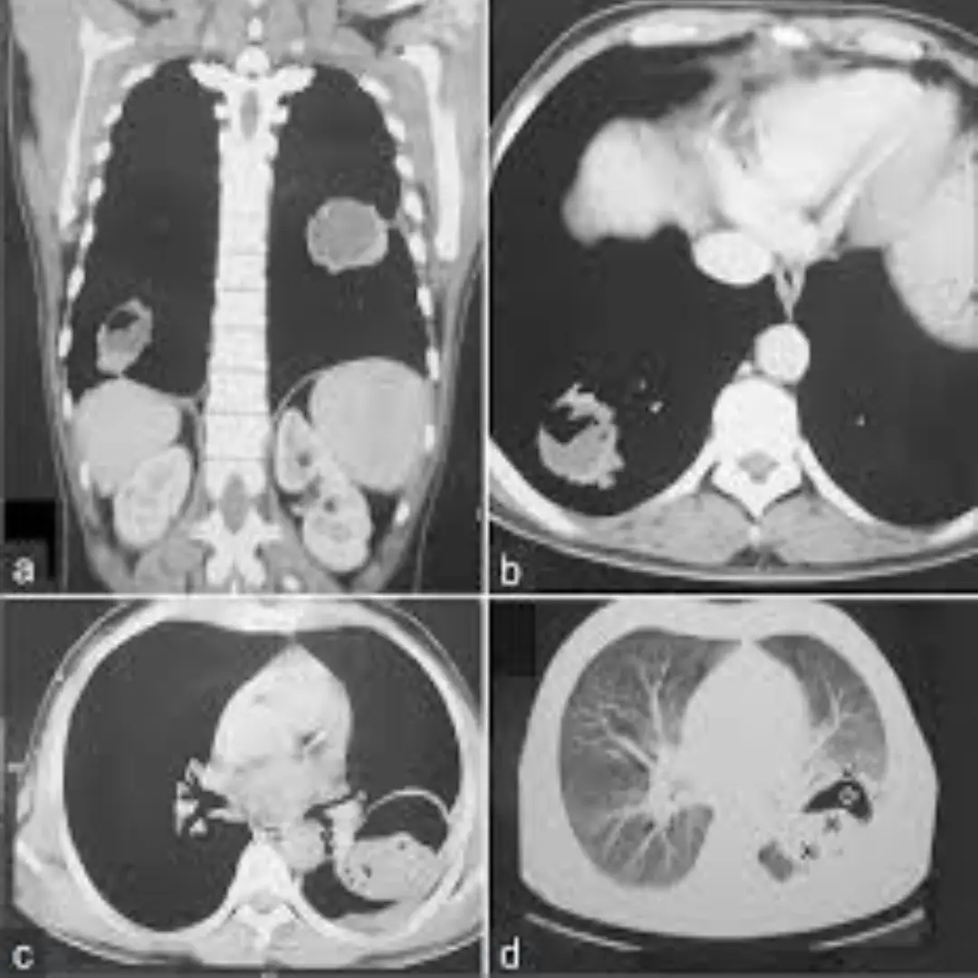 CECT CHEST (CONTRAST)