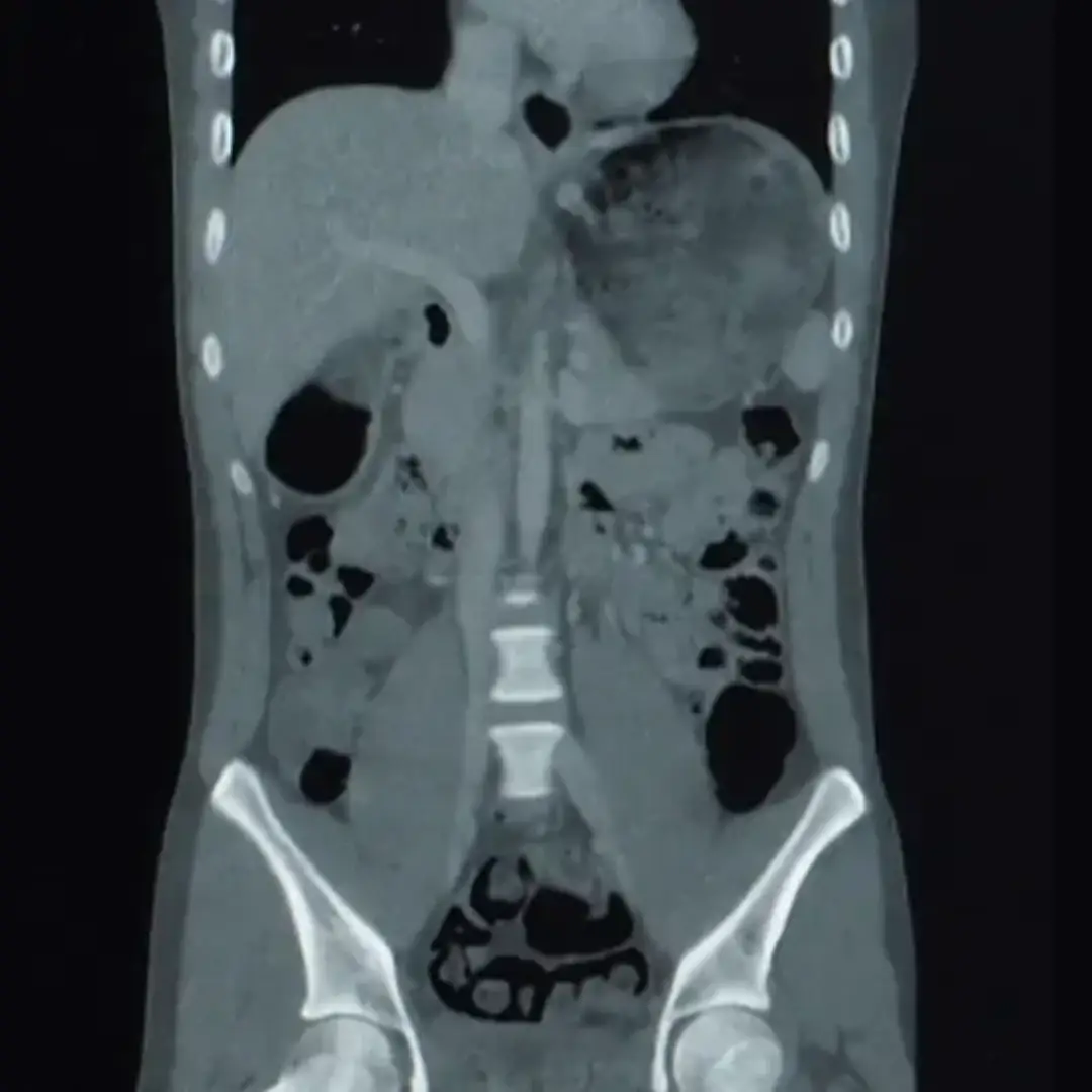 CECT UPPER ABDOMEN (CONTRAST)