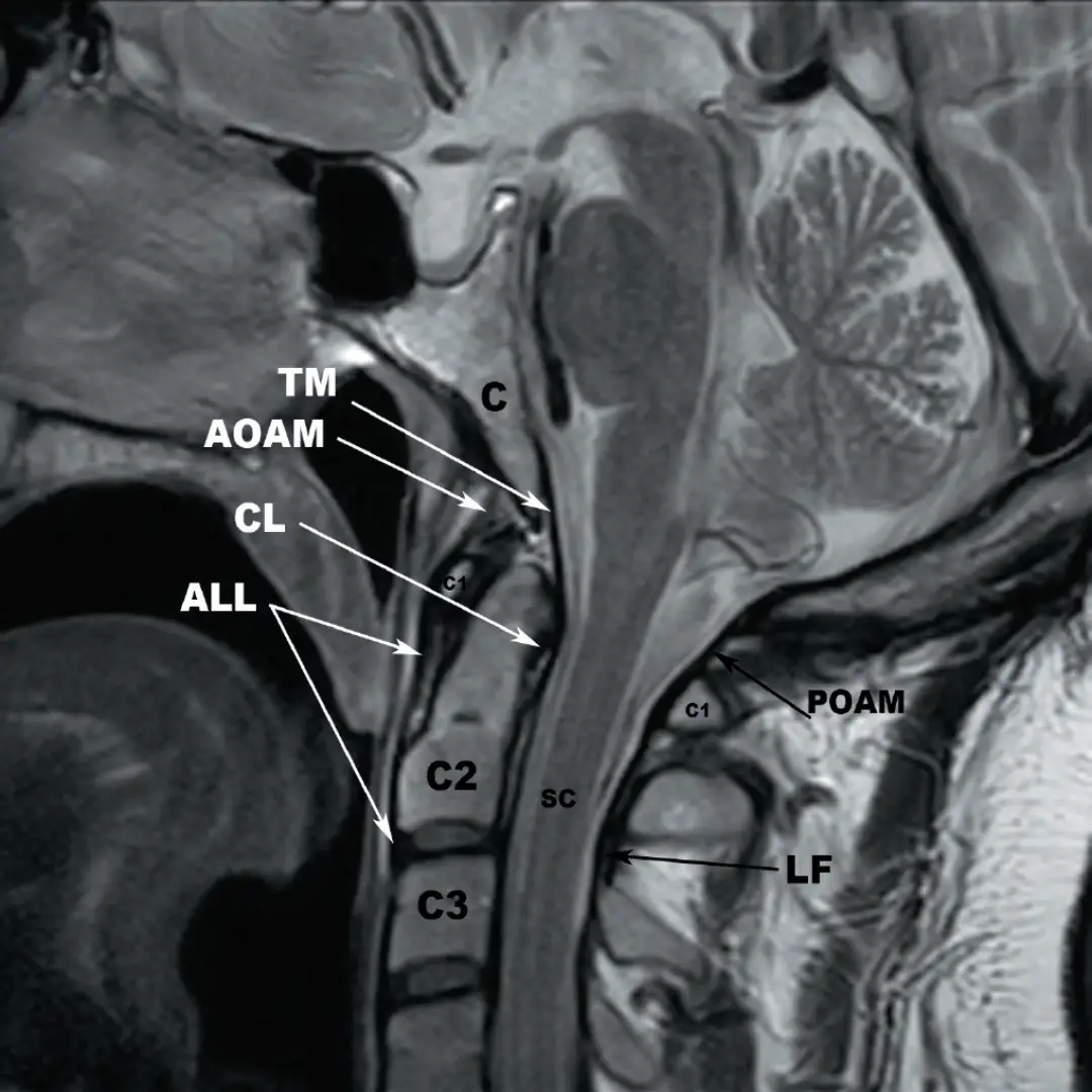 NCCT CRANIO VERTEBRAL JUNCTION (PLAIN)