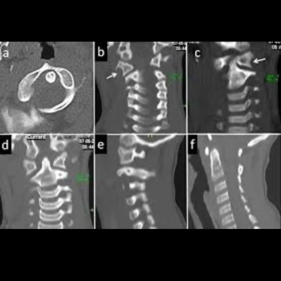 CECT CRANIO VERTEBRAL JUNCTION (CONTRAST)