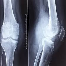 CECT BOTH KNEE (CONTRAST)