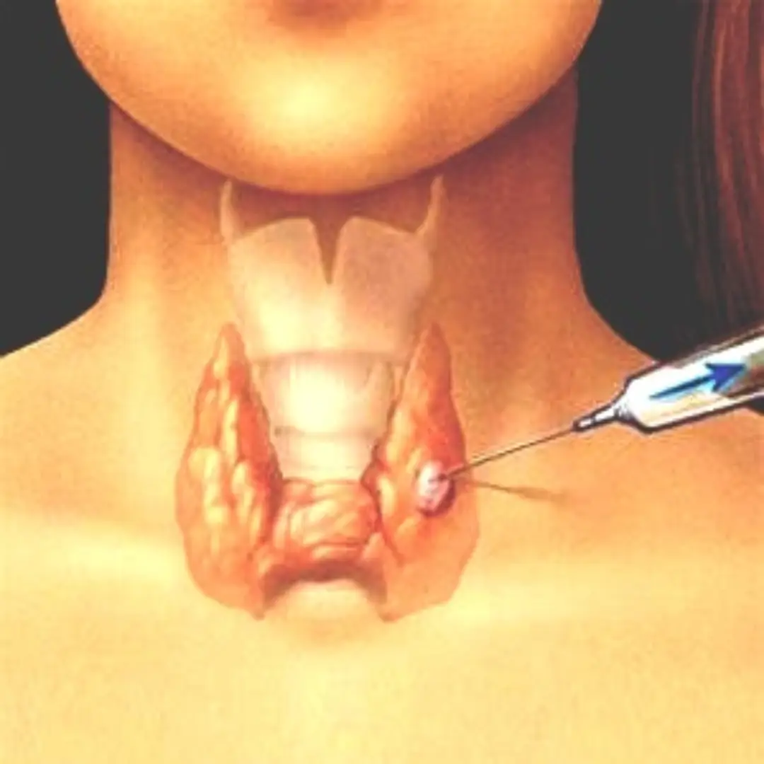 CT GUIDED FNAC OR BIOPSY