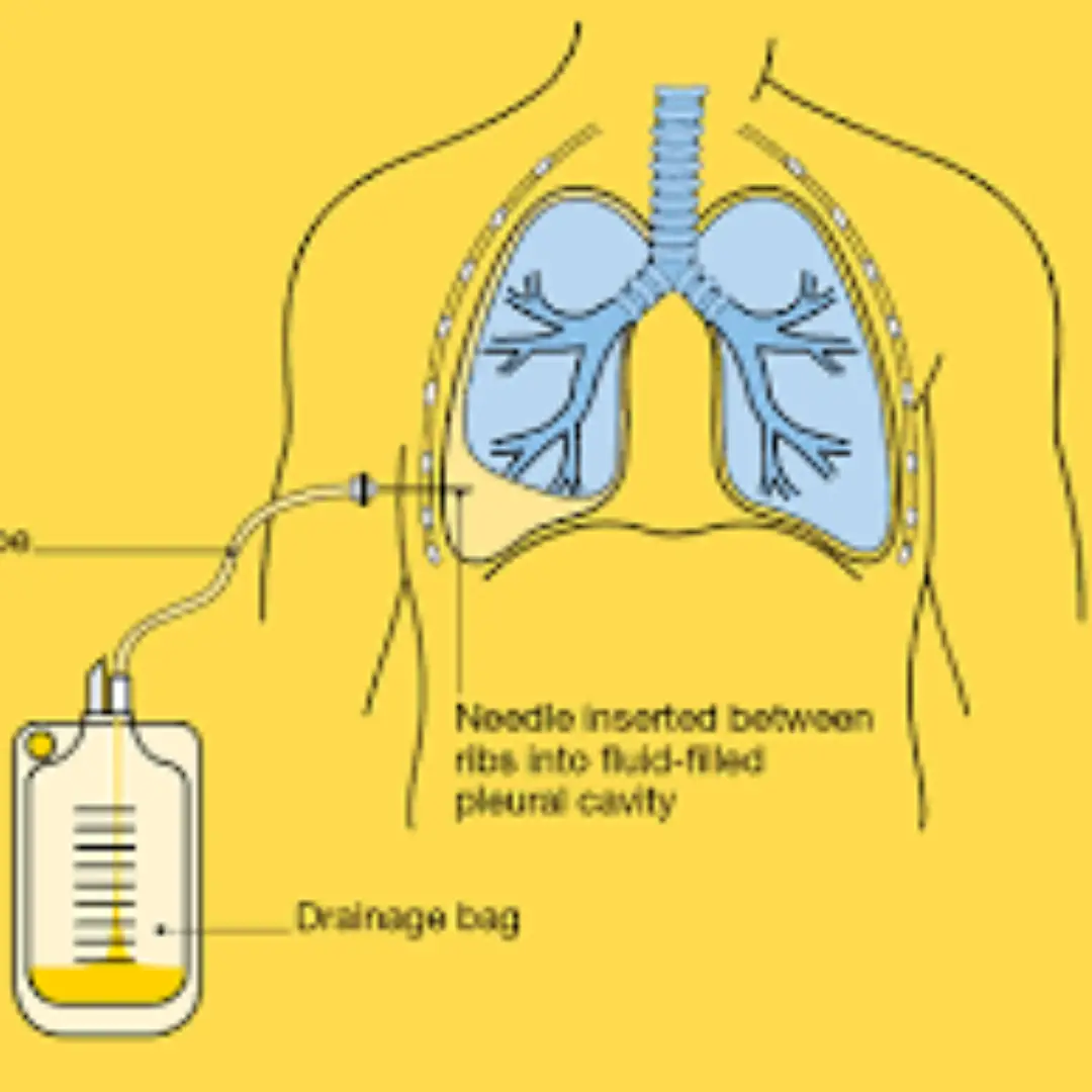 CT GUIDED PLEURAL TAP (THERAPEUTIC)